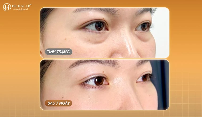 Tại Bệnh viện Thẩm mỹ Dr.Hải Lê, quy trình sửa mí dưới lỗi hỏng được thực hiện nghiêm ngặt dựa trên nền tảng công nghệ phục hồi đỉnh cao