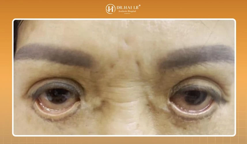 Bệnh viện Thẩm mỹ Dr.Hải Lê tự hào được đánh giá là trung tâm y tế sửa mí lỗi hỏng, mí lật khắc phục mọi tình trạng