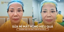 Sửa mí mắt hỏng hiệu quả tại Dr.Hải Lê?
