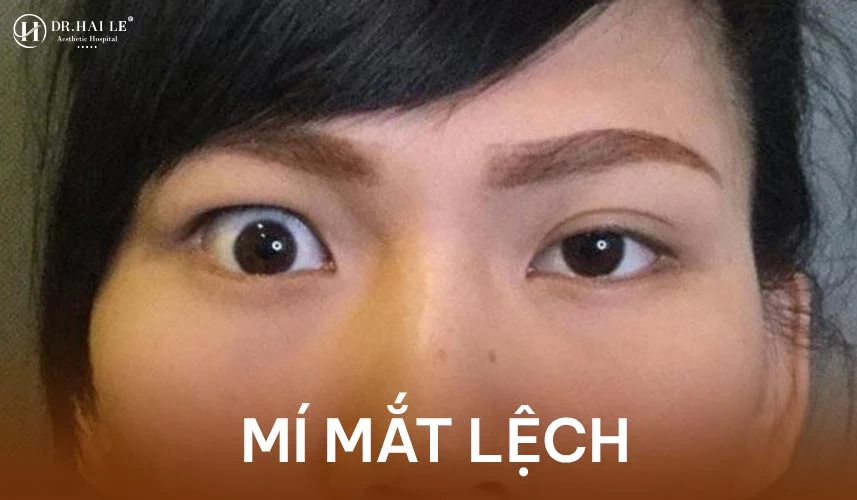 Sửa mí mắt hỏng là một quá trình phẫu thuật tái tạo cấu trúc vi phẫu, nhằm khắc phục triệt để các tổn thương cơ học và mô mềm