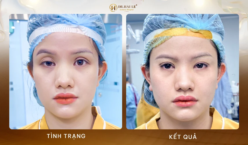 Quy trình thực hiện sửa mí mắt an toàn hạn chế sẹo