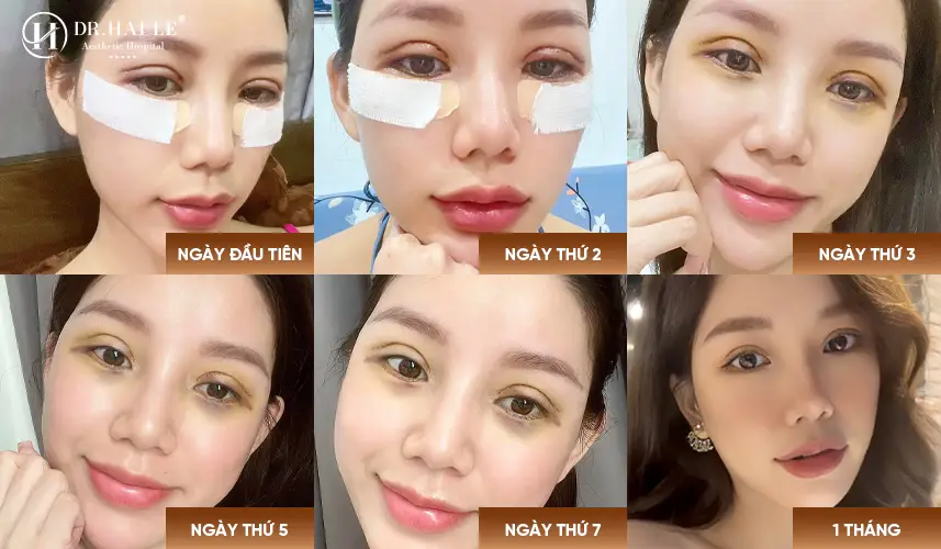 Sửa mí mắt không cần nghỉ dưỡng là kỹ thuật chỉnh sửa mí theo hướng hạn chế xâm lấn