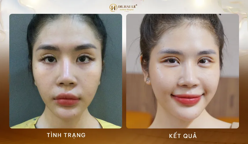 Ứng dụng công nghệ năng lượng sinh học tia Plasma lạnh sau sửa mí