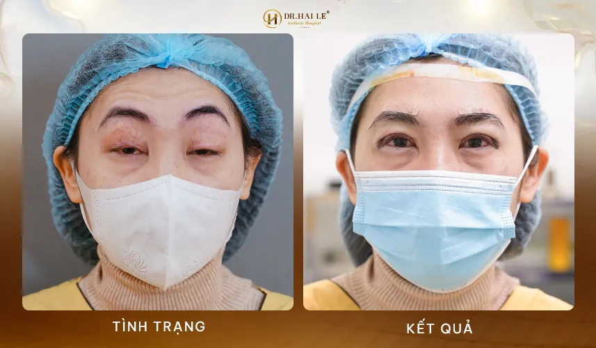 Những sai lầm nguy hiểm cần tránh để không bị mí lỗi hỏng