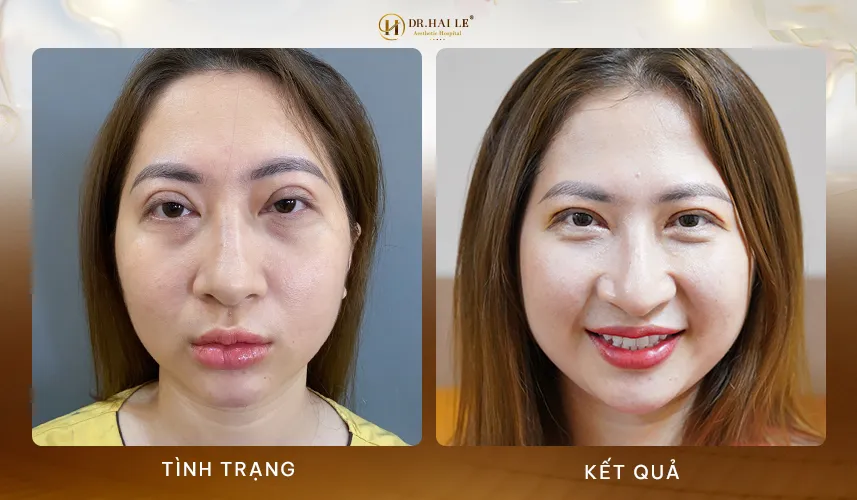Sửa mí không đau rát an toàn cùng Dr.Hải Lê