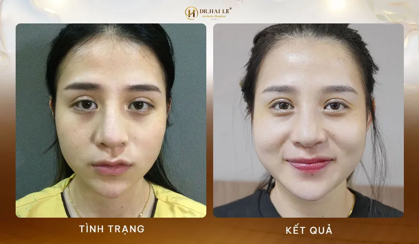 Sửa mí mắt không đau tại Dr.Hải Lê - Uy tín, chất lượng, an toàn 7 Quy trình sửa mí mắt không đau an toàn hiệu quả tại Dr.Hải Lê