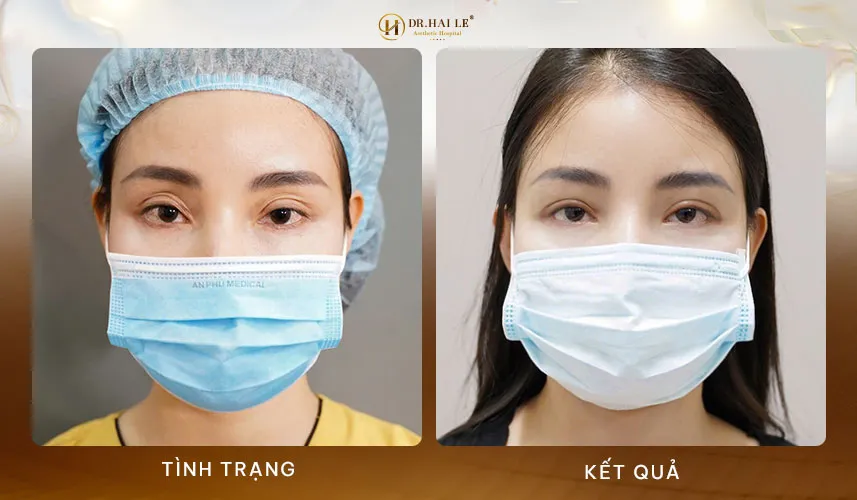 Sửa mí mắt không đau tại Dr.Hải Lê - Uy tín, chất lượng, an toàn 5 Quy trình sửa mí mắt không đau an toàn hiệu quả