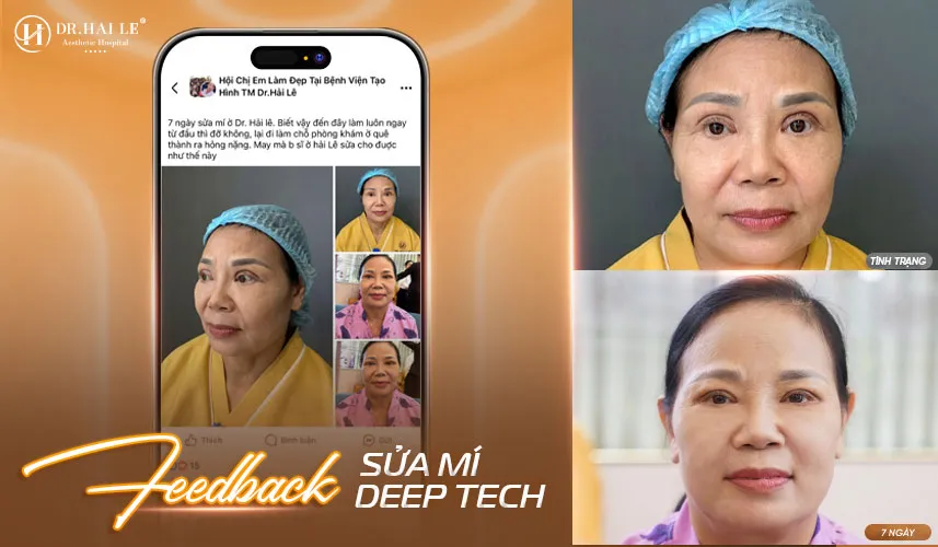 Sửa mí mắt không đau tại Dr.Hải Lê - Uy tín, chất lượng, an toàn 3 Sửa mí mắt không đau là gì?