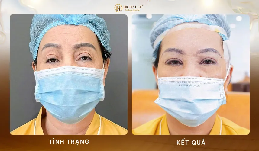 Quy trình thực hiện sửa mí an toàn tại Dr.Hải Lê