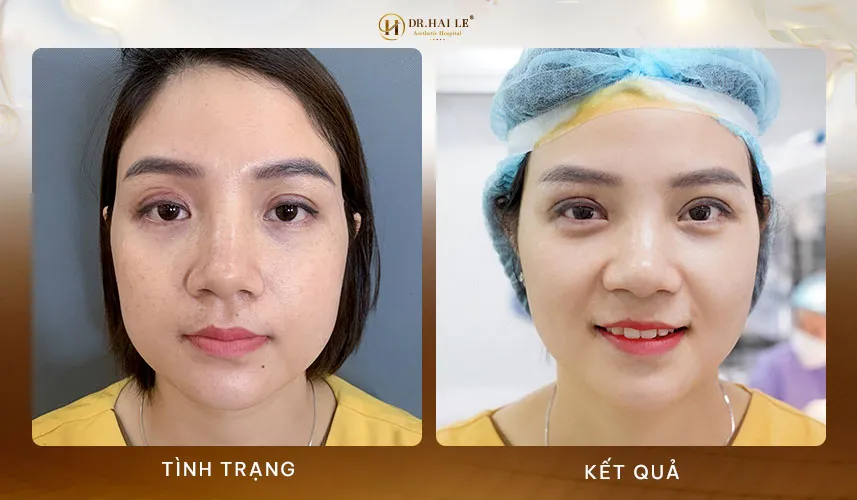 Sửa mí mắt không sưng kiến tạo nhan sắc an toàn cùng Dr.Hải Lê