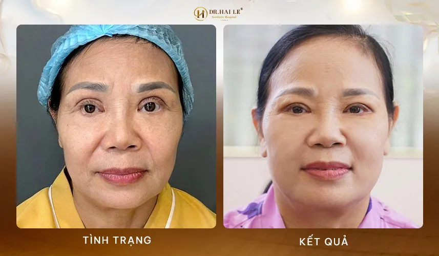 Sửa mí mắt không sưng là gì?