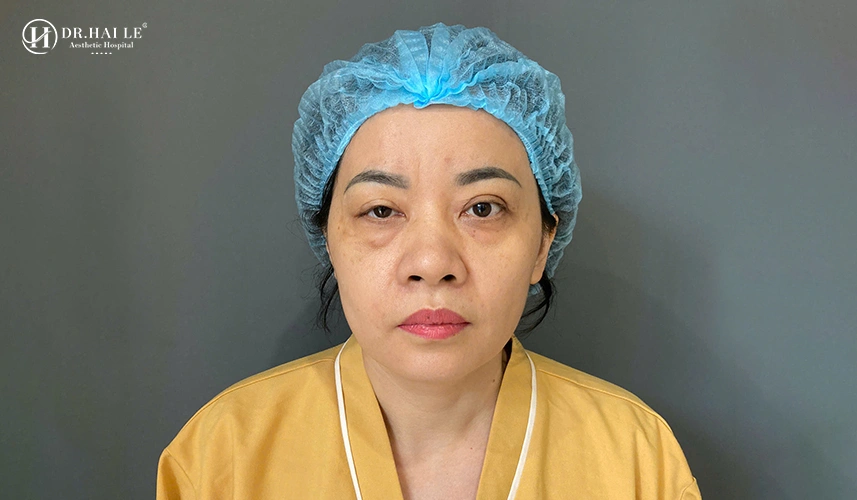Mí mắt lệch phải thường xuất phát từ cấu trúc giải phẫu bẩm sinh hoặc là hệ quả của quá trình lão hóa