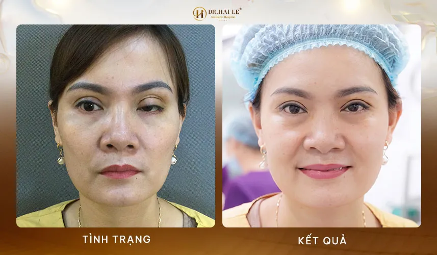Lời khuyên từ bác sĩ Dr.Hải Lê về vấn đề cắt sửa mí hiện nay