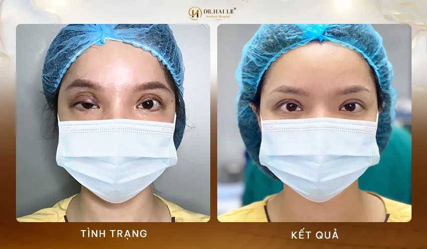 Sửa mí mắt nhanh chóng an toàn tại bệnh viện thẩm mỹ Dr.Hải Lê
