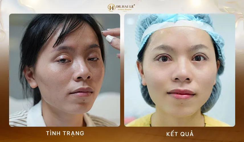 Các phương pháp sửa mí mắt hiện đại an toàn phục hồi nhanh