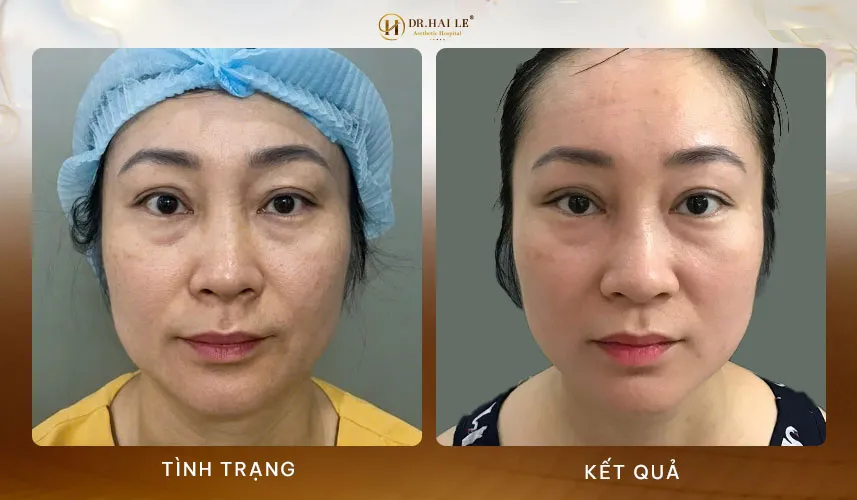 Sửa mí mắt nhanh chóng là gì?