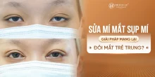 Sửa mí mắt sụp mí: Giải pháp mang lại đôi mắt trẻ trung?