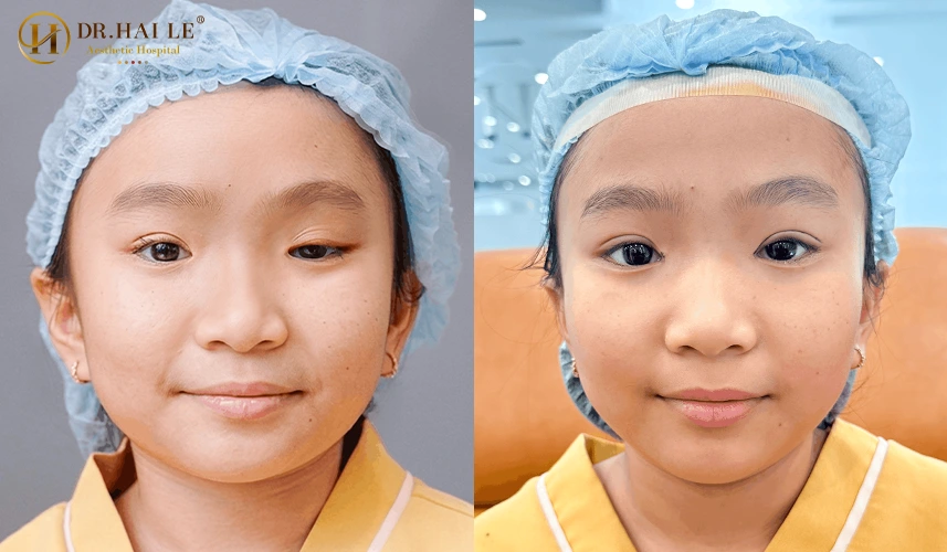 Phẫu thuật sửa mí mắt sụp mí tại Dr.Hải Lê không chỉ dừng lại ở việc cắt bỏ da thừa. Đây là một quy trình can thiệp sâu vào cấu trúc giải phẫu