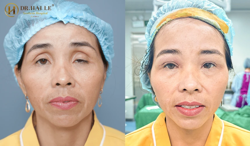 Mọi ca phẫu thuật sửa mí mắt sụp mí đều được thực hiện theo tiêu chuẩn 5 sao, đảm bảo tính vô trùng