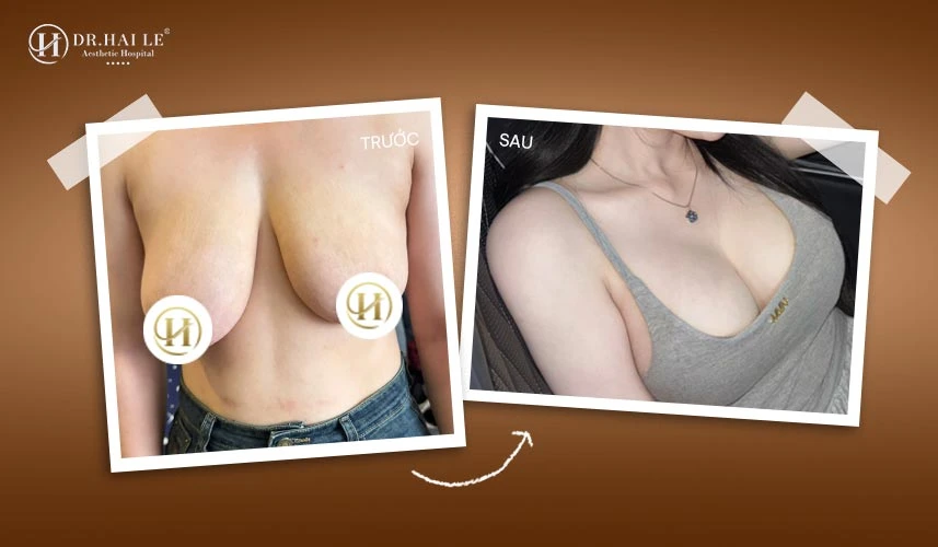 Tạo Hình Ngực Sa Trễ 2 So sánh hình ảnh trước – sau tạo hình ngực sa trễ