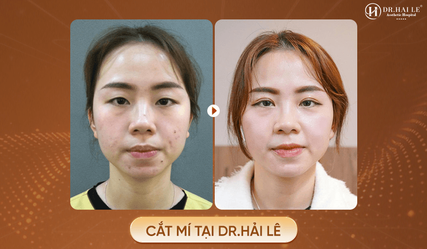 truoc va sau khi cat mi tai drhaile 1