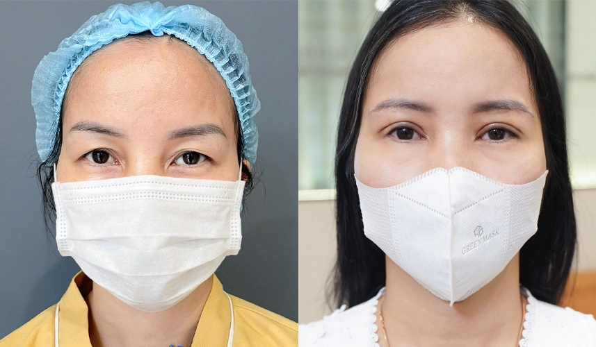 Để trả lời trực tiếp cho câu hỏi "Cắt mí có vĩnh viễn không?", xét trên góc độ y khoa lâm sàng, câu trả lời là Không