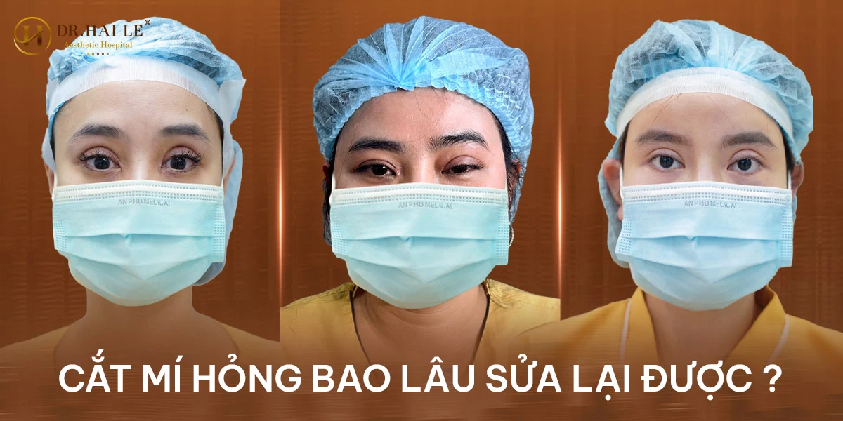 Cắt mí hỏng bao lâu sửa lại được?