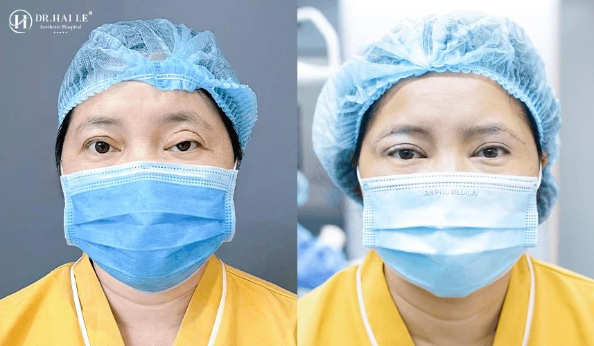 Cắt mí hỏng bao lâu sửa lại được mốc thời gian tiêu chuẩn để can thiệp an toàn là từ 3 đến 6 tháng sau lần mổ đầu tiên