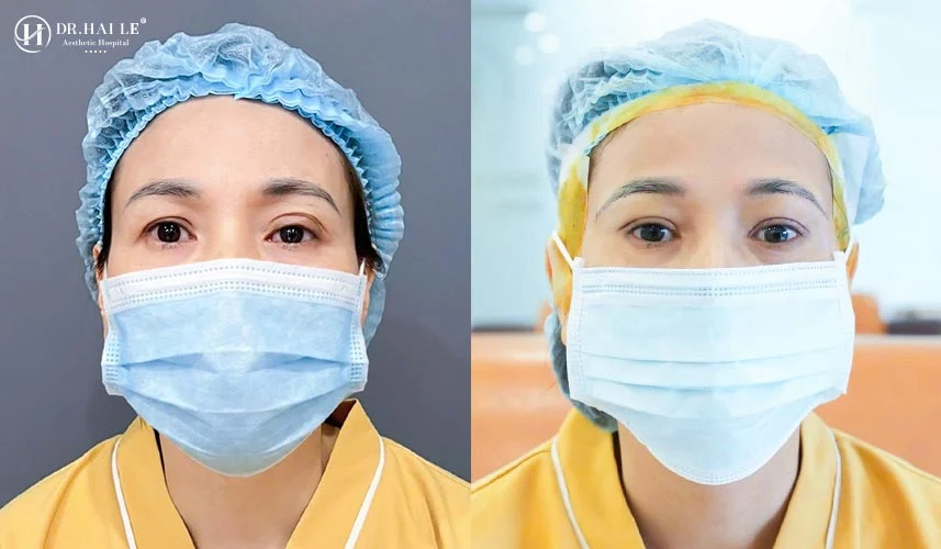 Phẫu thuật chỉnh sửa mí hỏng là một danh mục kỹ thuật vi phẫu đặc biệt khó, đòi hỏi nền tảng y tế chất lượng cao
