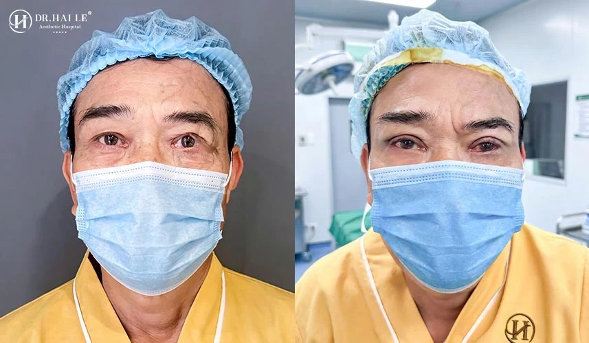 Hành trình tìm lại đôi mắt đẹp tự nhiên sau biến chứng thẩm mỹ là một chặng đường đòi hỏi sự cẩn trọng y khoa tuyệt đối