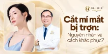 Cắt mí mắt bị trợn: Nguyên nhân và cách khắc phục?