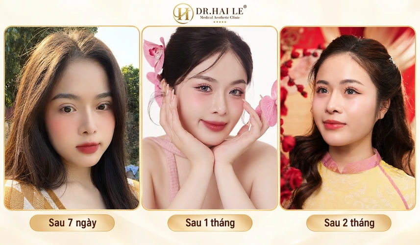 Hình ảnh giai đoạn khách hàng từ ngày đầu đến 3 tháng sau khi cắt mí tại Dr.Hải Lê