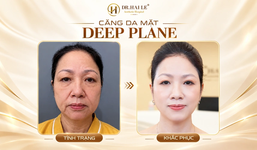 Tìm hiểu & phân tích phương pháp căng da mặt phẫu thuật? 2 Sự thay đổi diện mạo sau căng da mặt Deep Plane là điều khách hàng quan tâm khi nhìn lại hành trình trẻ hóa tại Dr. Hải Lê.