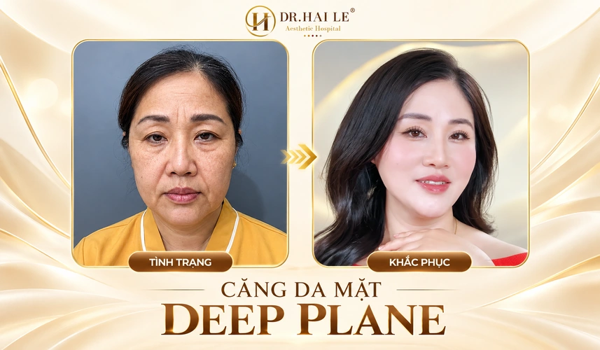 Tìm hiểu & phân tích phương pháp căng da mặt phẫu thuật? 7 Với khách hàng, niềm vui sau căng da mặt Deep Plane còn là cảm giác tự tin khi trang điểm, làm tóc và lựa chọn trang phục yêu thích.