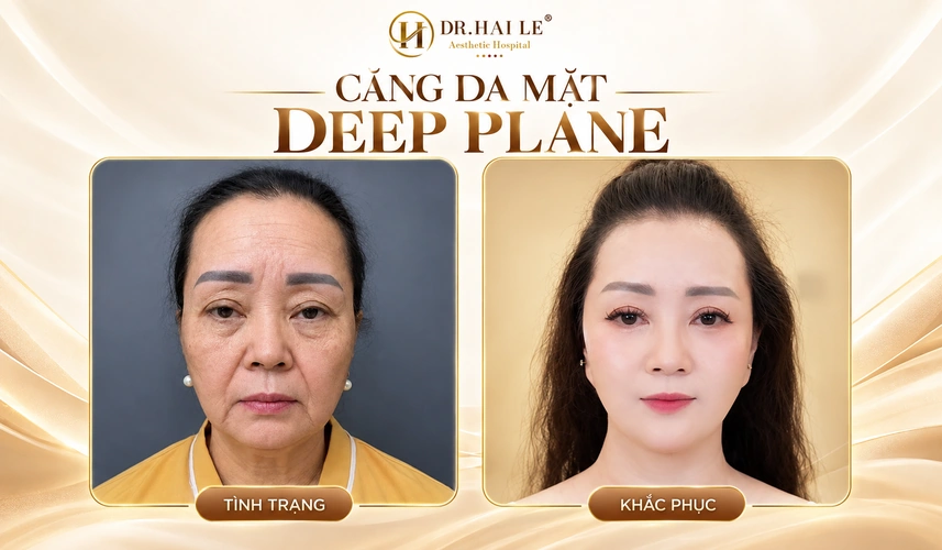 Khách hàng đánh giá kết quả căng da mặt Deep Plane qua sự thay đổi ở vùng má, rãnh mũi má và đường viền hàm.