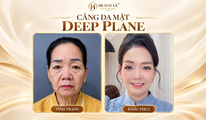Tìm hiểu & phân tích phương pháp căng da mặt phẫu thuật? 5 Nụ cười của khách hàng trong bức ảnh sau căng da mặt Deep Plane ghi lại một khoảnh khắc đáng nhớ trên hành trình làm đẹp.