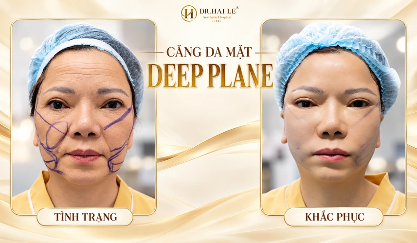 Hình ảnh thực tế giúp khách hàng hiểu rõ hơn về quá trình căng da mặt Deep Plane và những thay đổi sau can thiệp.