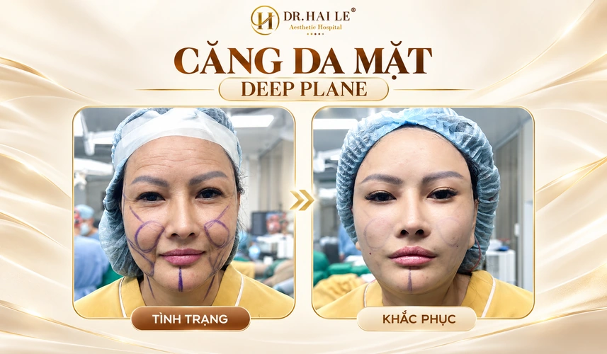 Sự hài lòng của khách hàng gắn liền với cả kết quả căng da mặt Deep Plane và trải nghiệm chăm sóc trong quá trình hồi phục.