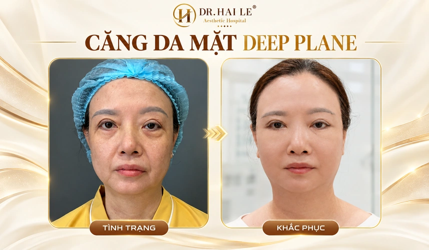 Căng da mặt mini bao nhiêu tiền? 3 Một diện mạo tươi tắn, hài hòa với đường nét sẵn có là mong muốn của khách hàng khi lựa chọn căng da mặt Deep Plane.