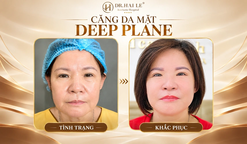 Căng da mặt mini bao nhiêu tiền? 5 Niềm vui khi nhìn lại hình ảnh của mình là một phần ý nghĩa trong trải nghiệm trẻ hóa bằng phương pháp Deep Plane.