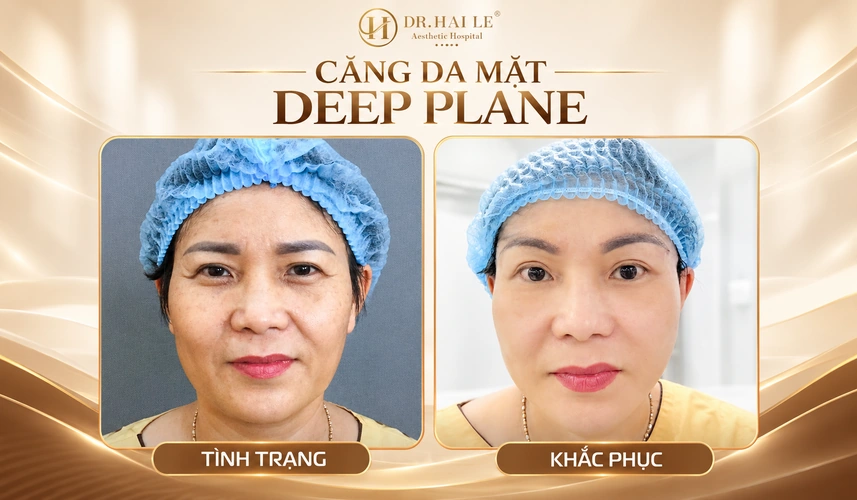 Căng da mặt mini bao nhiêu tiền? 7 Hình ảnh đối chiếu giúp khách hàng theo dõi sự thay đổi của gương mặt sau căng da mặt Deep Plane tại Dr. Hải Lê.