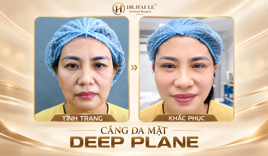 Khoảnh khắc khách hàng mỉm cười sau căng da mặt Deep Plane mang đến góc nhìn gần gũi về hành trình thay đổi diện mạo.