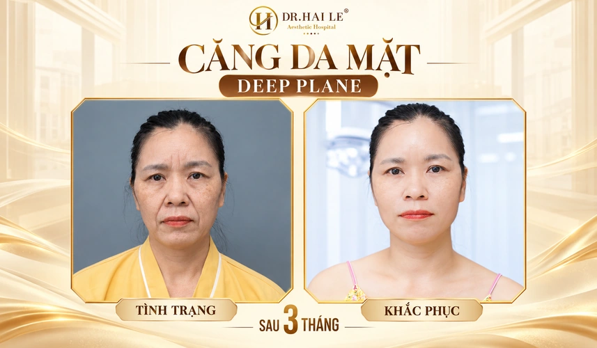 Hình ảnh sau 3 tháng giúp khách hàng nhìn lại và đánh giá kết quả căng da mặt Deep Plane theo thời gian.