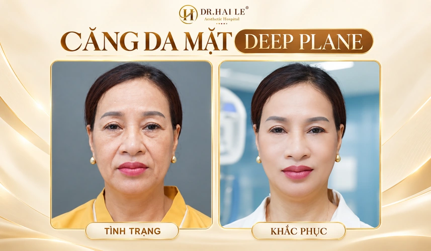 Với khách hàng lựa chọn căng da mặt Deep Plane, sự hài lòng đến từ diện mạo phù hợp với mong đợi và nét riêng của bản thân.