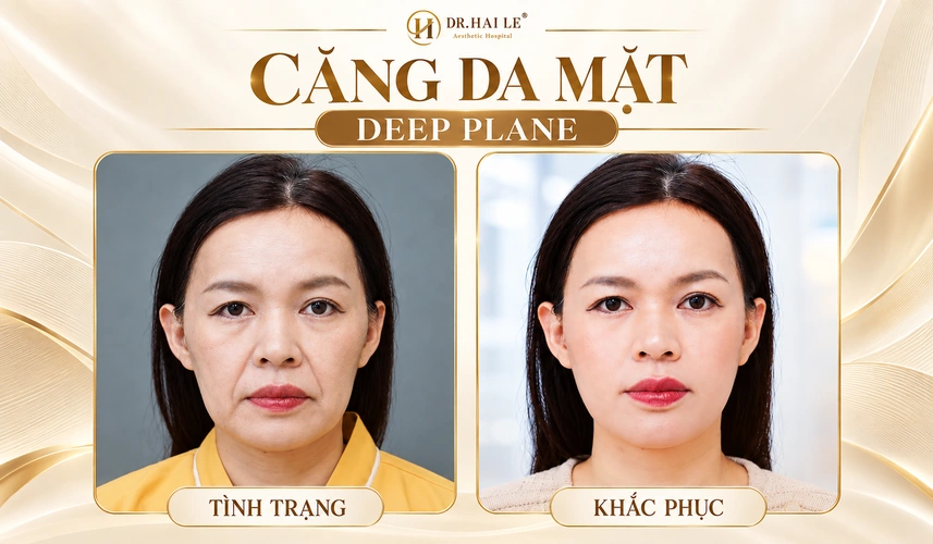 Hành trình căng da mặt Deep Plane được ghi lại bằng hình ảnh thực tế, giúp khách hàng nhận thấy sự thay đổi của chính mình.
