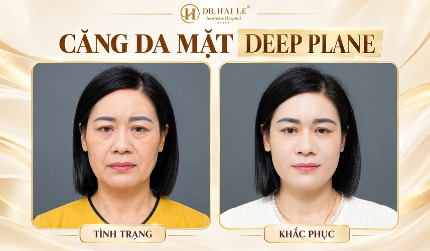 Khách hàng tìm đến căng da mặt Deep Plane với mong muốn làm mới diện mạo và cảm thấy tự tin hơn trong cuộc sống thường ngày.