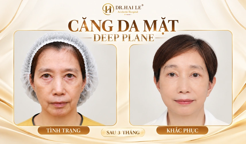 Sau 3 tháng căng da mặt Deep Plane, hình ảnh tái khám là dấu mốc để khách hàng chia sẻ cảm nhận về diện mạo mới.