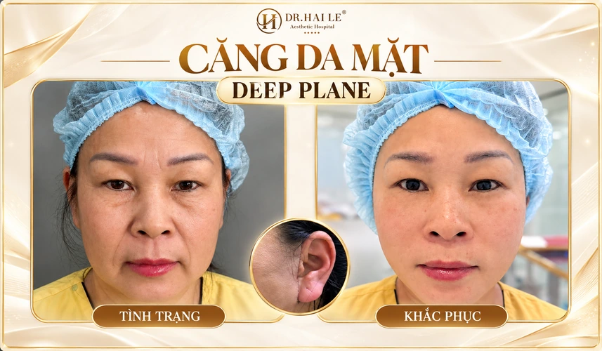 Bên cạnh đường nét gương mặt, khách hàng cũng quan tâm đến vùng đường mổ quanh tai khi đánh giá trải nghiệm căng da mặt Deep Plane.
