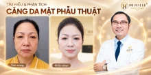Tìm hiểu phương pháp căng da mặt phẫu thuật