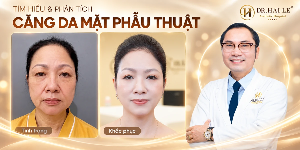Tìm hiểu & phân tích phương pháp căng da mặt phẫu thuật? 1 Tìm hiểu phương pháp căng da mặt phẫu thuật